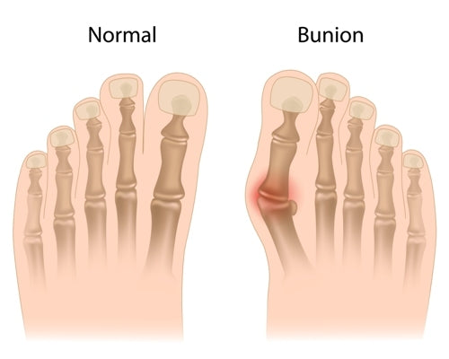 Bunions: What Actually Helps, What Doesn't, and What the Trials Show